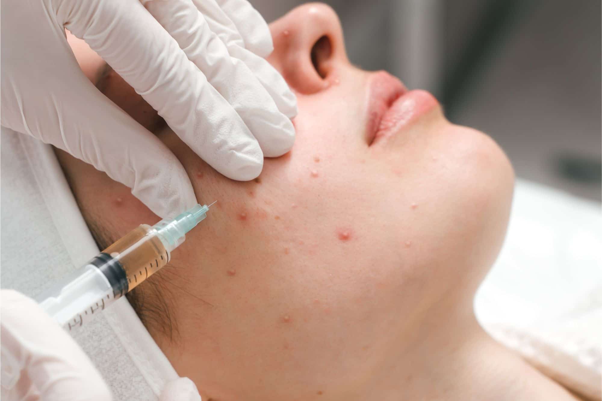 Hormonal Pimple Treatment Price Malaysia: Solutions & Prevention